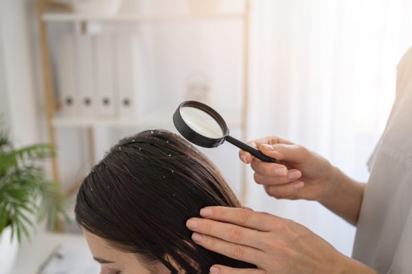 close-up-woman-with-dandruff-doctor